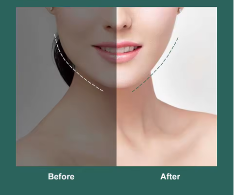 Face Lift Up Belt – Cinturón Reafirmante Facial para Reducir Papada y Tonificar el Rostro | MisterTodo Perú - MisterTodo